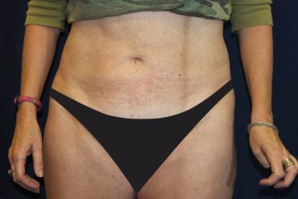 Tummy Tuck Before & After Patient #4192