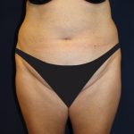 Tummy Tuck Before & After Patient #4192