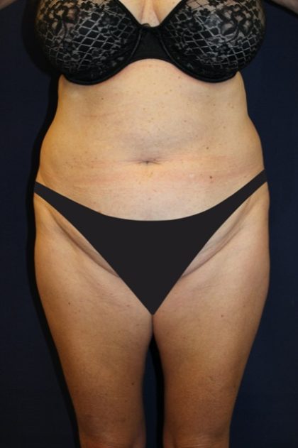 Tummy Tuck Before & After Patient #4192