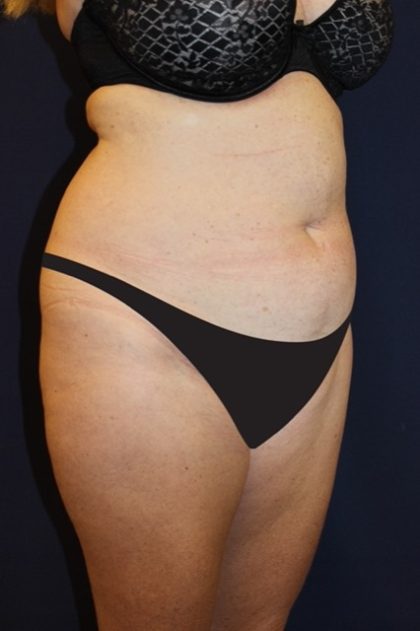 Tummy Tuck Before & After Patient #4179