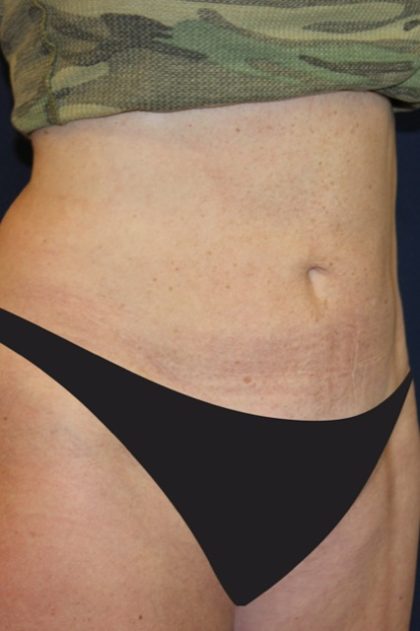 Tummy Tuck Before & After Patient #4179