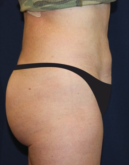 Tummy Tuck Before & After Patient #4179