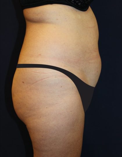 Tummy Tuck Before & After Patient #4179