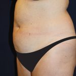 Tummy Tuck Before & After Patient #4179