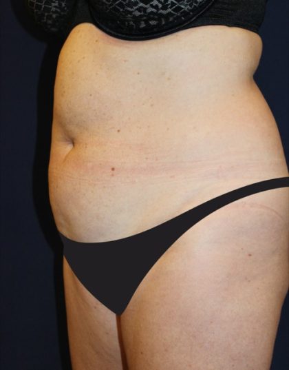 Tummy Tuck Before & After Patient #4179