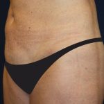 Tummy Tuck Before & After Patient #4179