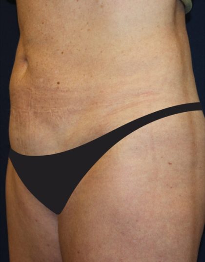 Tummy Tuck Before & After Patient #4179