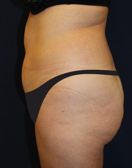 Tummy Tuck Before & After Patient #4179