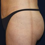 Tummy Tuck Before & After Patient #4179