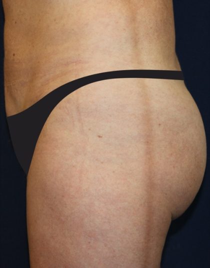 Tummy Tuck Before & After Patient #4179