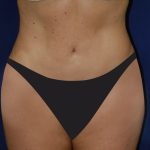 Tummy Tuck Before & After Patient #4179