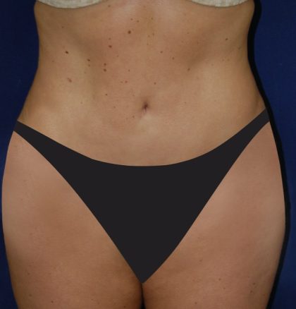 Tummy Tuck Before & After Patient #4179