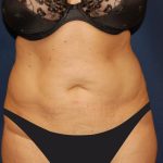 Tummy Tuck Before & After Patient #4179