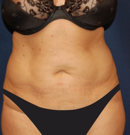 Tummy Tuck Before & After Patient #4179