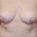 Breast Reduction Before & After Patient #4416