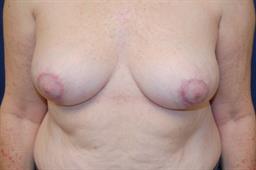 Breast Reduction Before & After Patient #4416