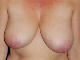 Breast Reduction Before & After Patient #4984