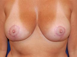 Breast Reduction Before & After Patient #4984