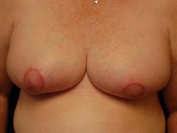 Breast Reduction Before & After Patient #4984