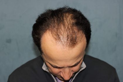 Hair Restoration Before & After Patient #4927