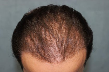 Hair Restoration Before & After Patient #4927