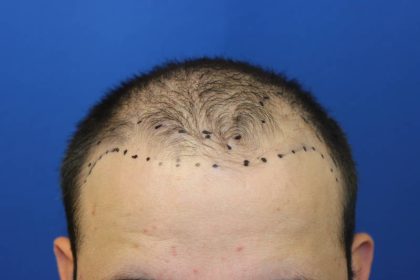 Hair Restoration Before & After Patient #4948