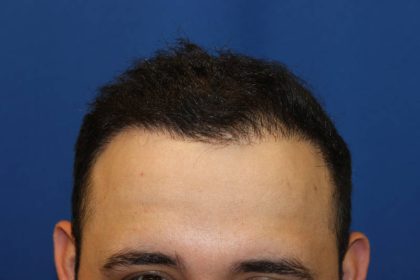 Hair Restoration Before & After Patient #4948