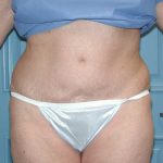 Liposuction Before & After Patient #4720