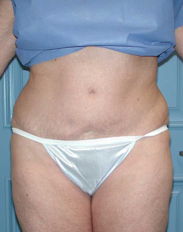 Liposuction Before & After Patient #4720