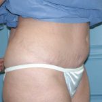 Liposuction Before & After Patient #4720