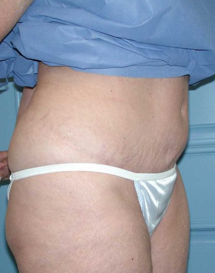 Liposuction Before & After Patient #4720