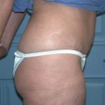 Liposuction Before & After Patient #4720