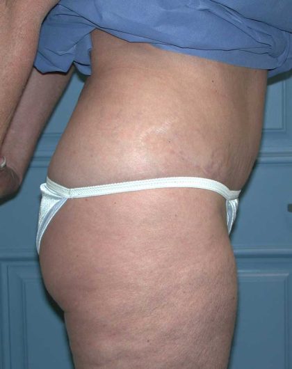 Liposuction Before & After Patient #4720