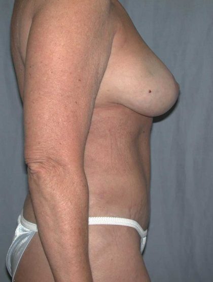 Liposuction Before & After Patient #4720
