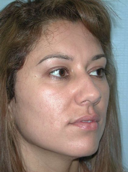 Rhinoplasty Before & After Patient #3695