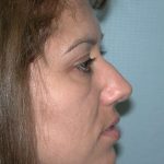 Rhinoplasty Before & After Patient #3695