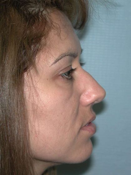 Rhinoplasty Before & After Patient #3695