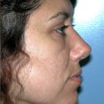 Rhinoplasty Before & After Patient #3695