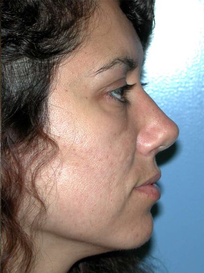 Rhinoplasty Before & After Patient #3695
