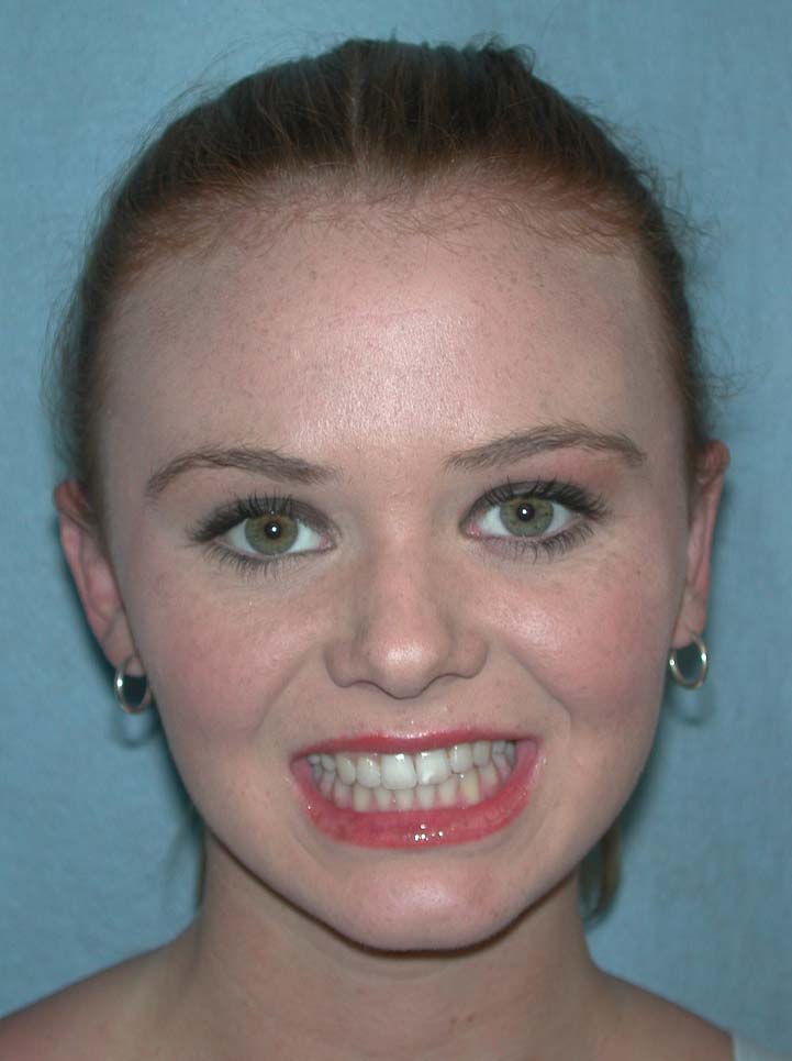 Otoplasty Before & After Patient #5022