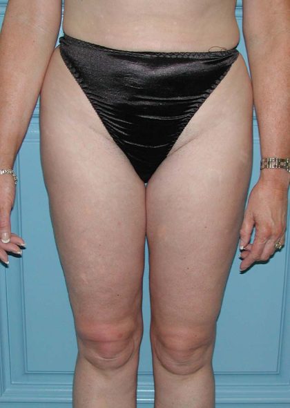 Liposuction Before & After Patient #5007