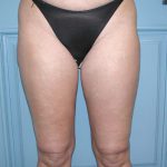 Liposuction Before & After Patient #5007