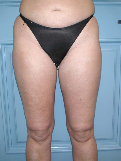 Liposuction Before & After Patient #5007