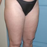 Liposuction Before & After Patient #5007