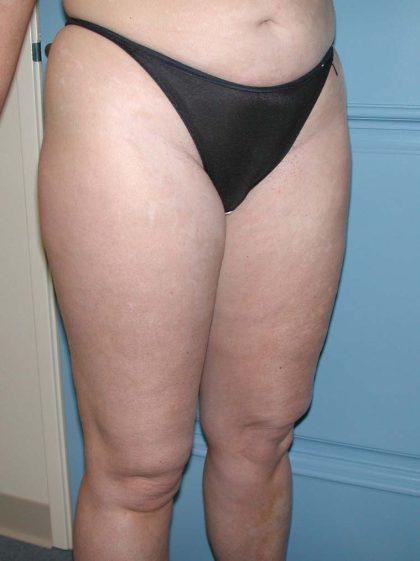 Liposuction Before & After Patient #5007