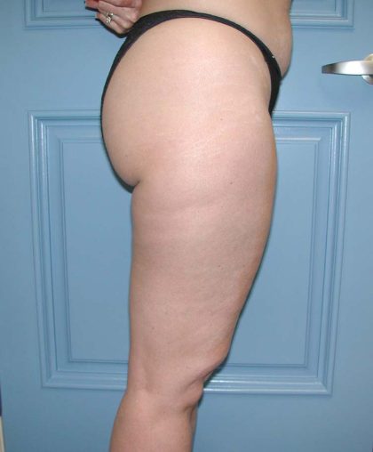 Liposuction Before & After Patient #5007