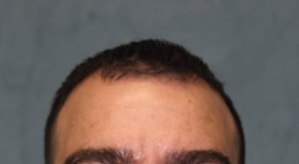 Hair Restoration Before & After Patient #4941
