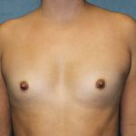 Breast Augmentation Before & After Patient #4350