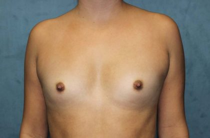 Breast Augmentation Before & After Patient #4350