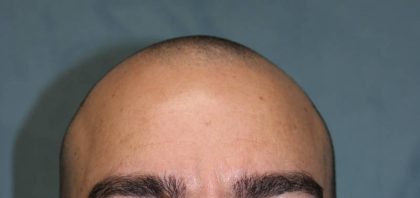 Hair Restoration Before & After Patient #4941